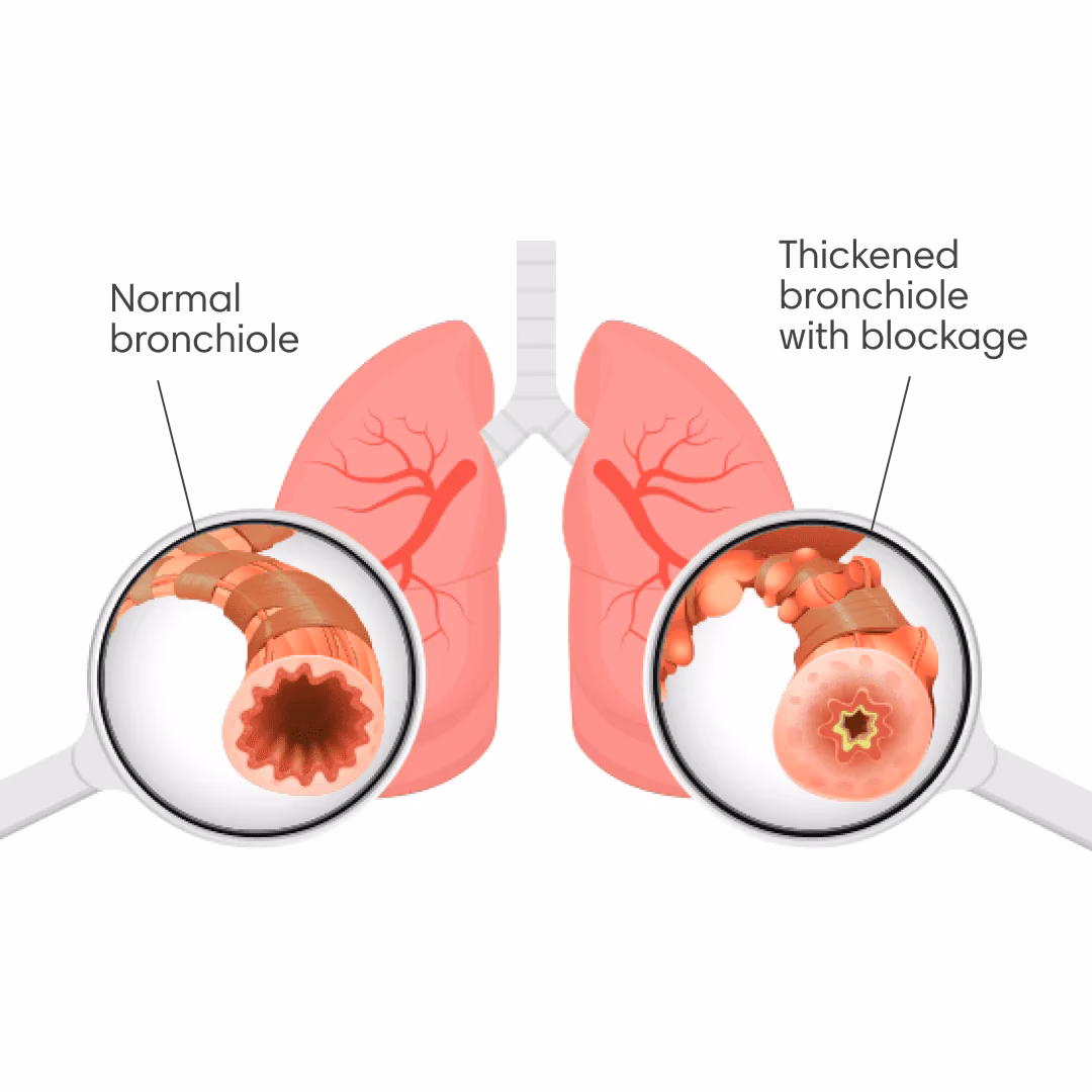What causes a crackling sound?