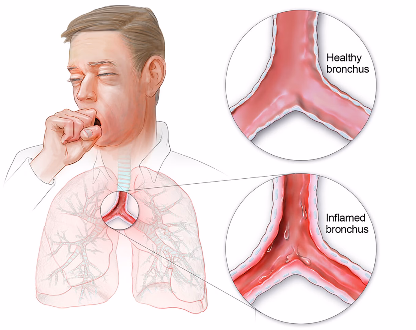 What is the treatment for acute bronchitis?