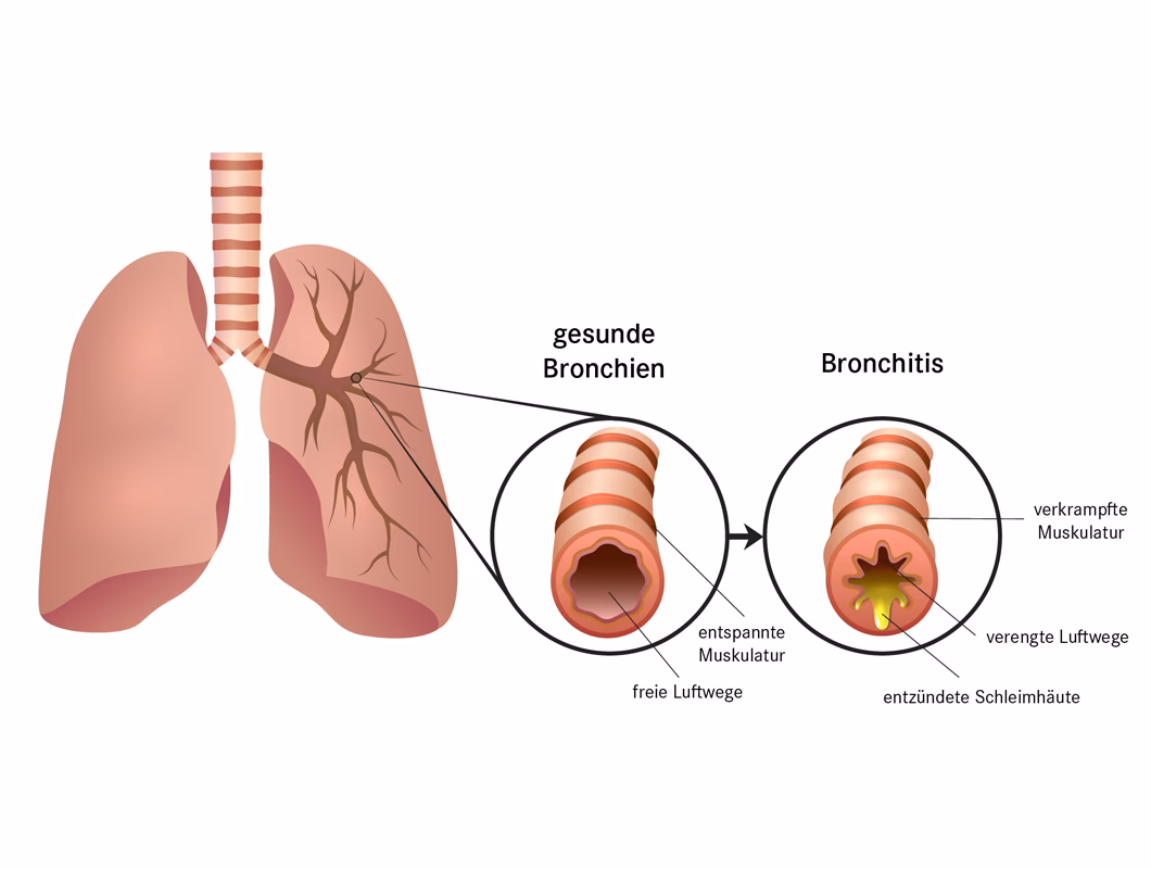 Wie diagnostiziert man eine Bronchitis?