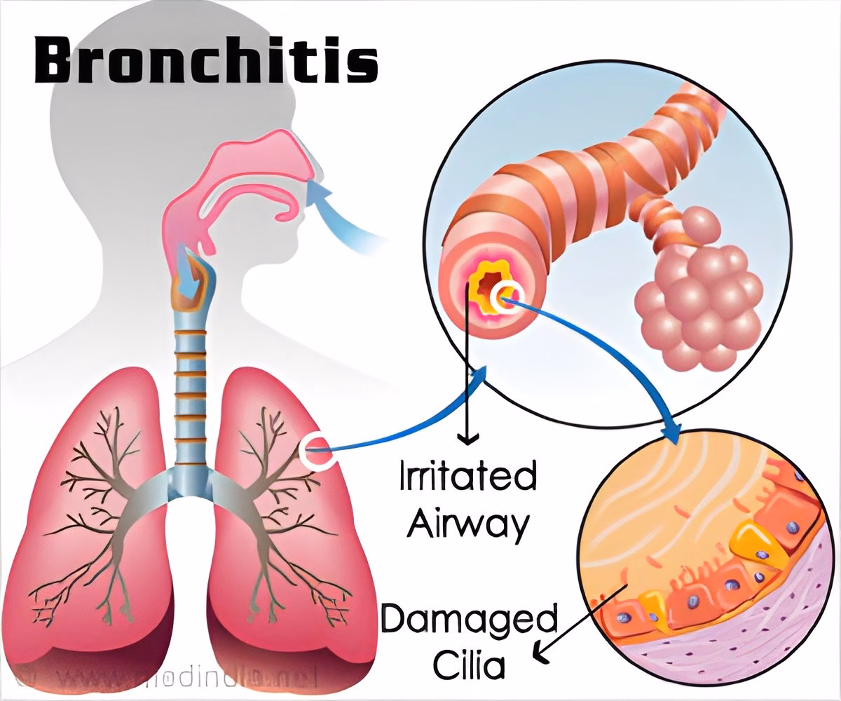 Does air quality affect bronchial asthma?