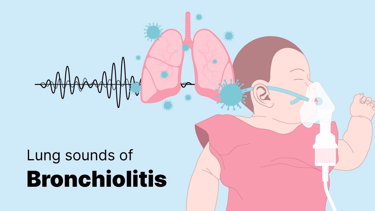 Do bronchial sounds signal fluid in the lungs?