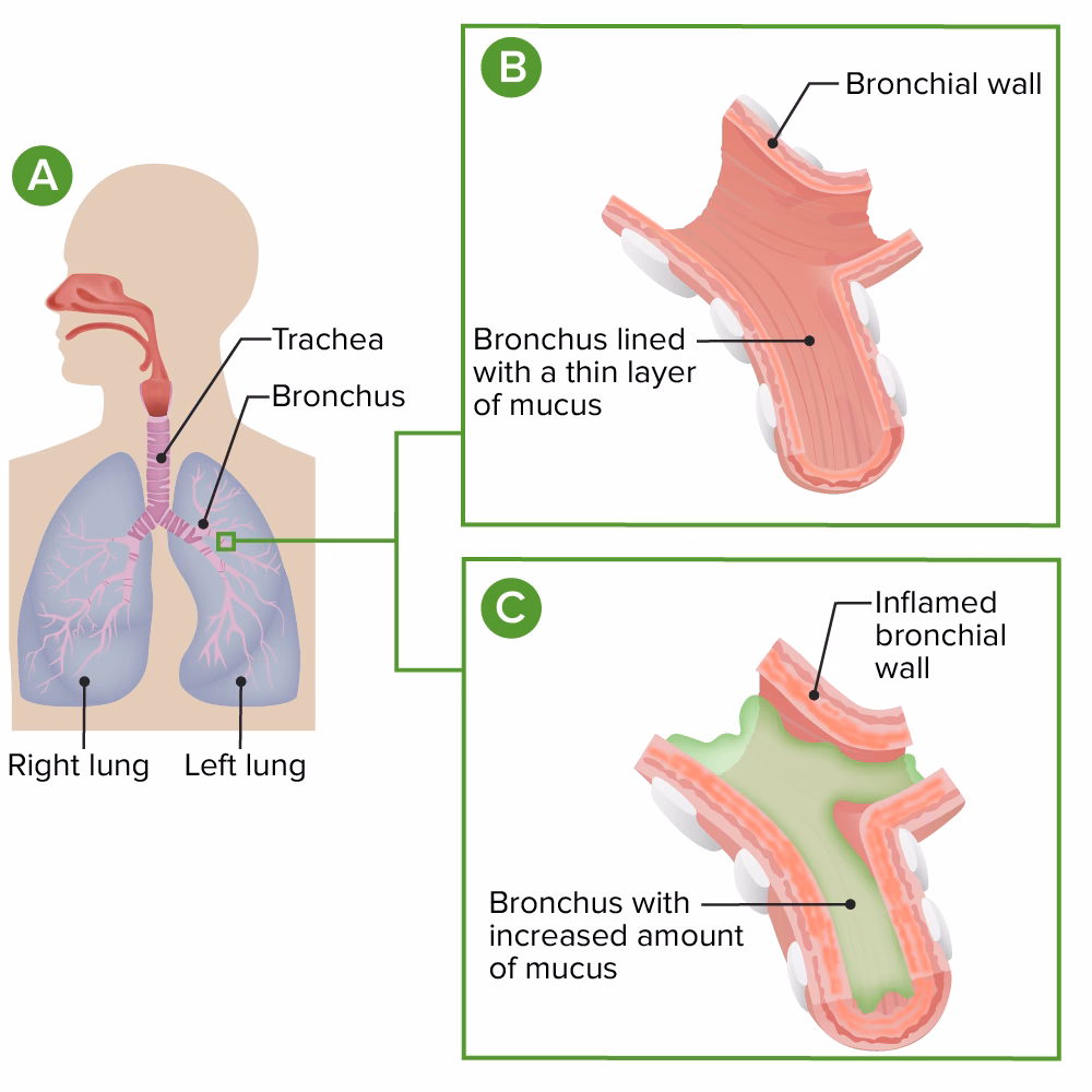 Wie kann man eine Bronchitis verhindern?