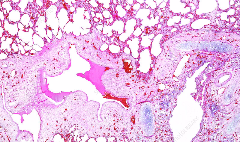 What are the histologic features of chronic bronchitis?