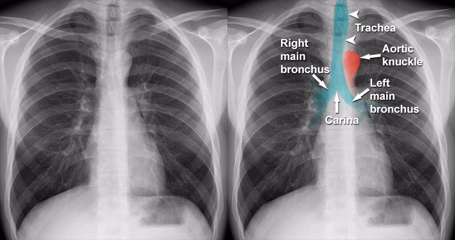 What does chronic bronchitis look like on an X-ray?