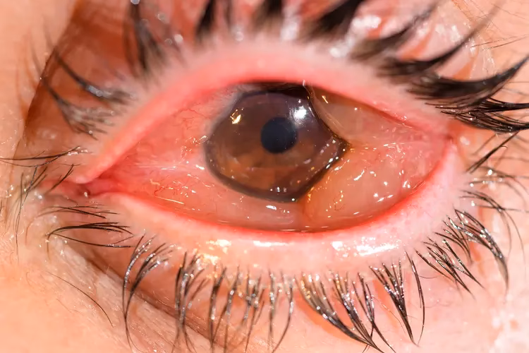 Can allergies cause blurry vision?