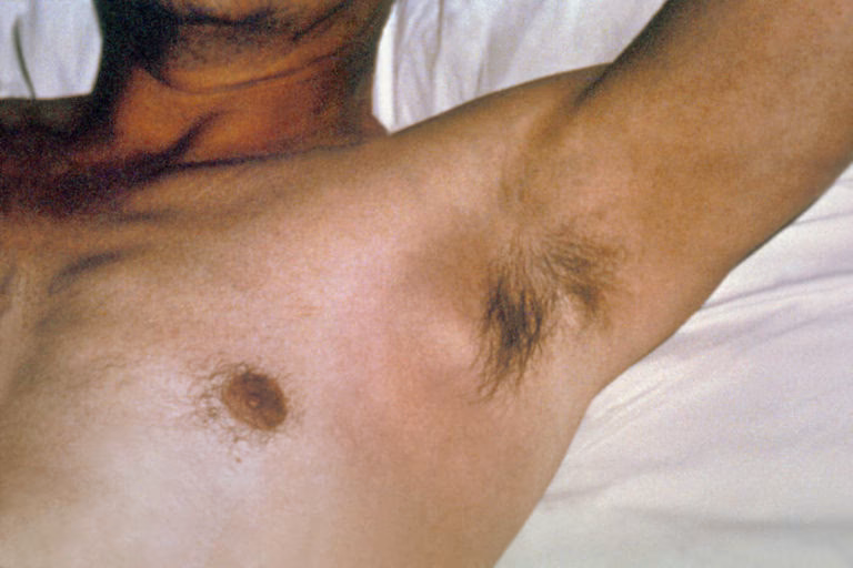 What is a bubo adenitis?