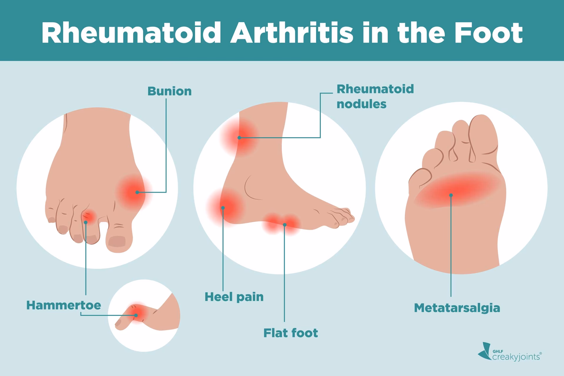 What is a bunion & what causes it?