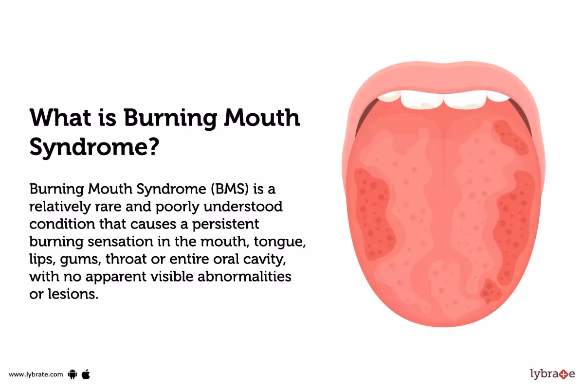 What is burning mouth syndrome (BMS)?
