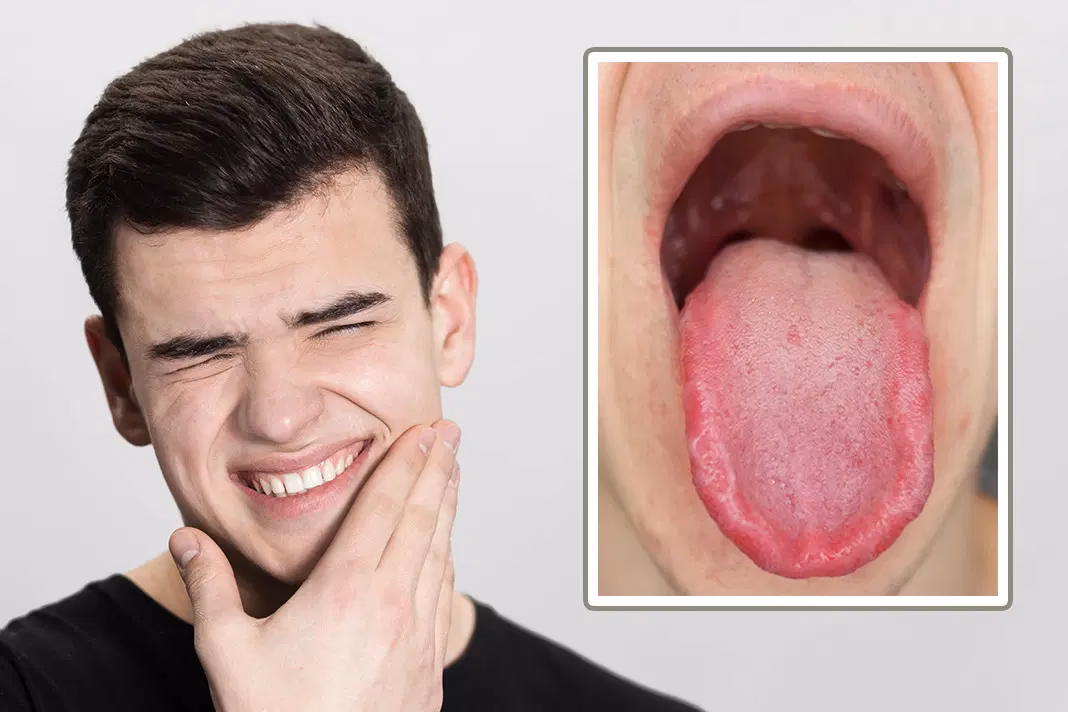 What causes burning mouth syndrome?