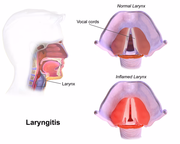 What is laryngotracheobronchitis?