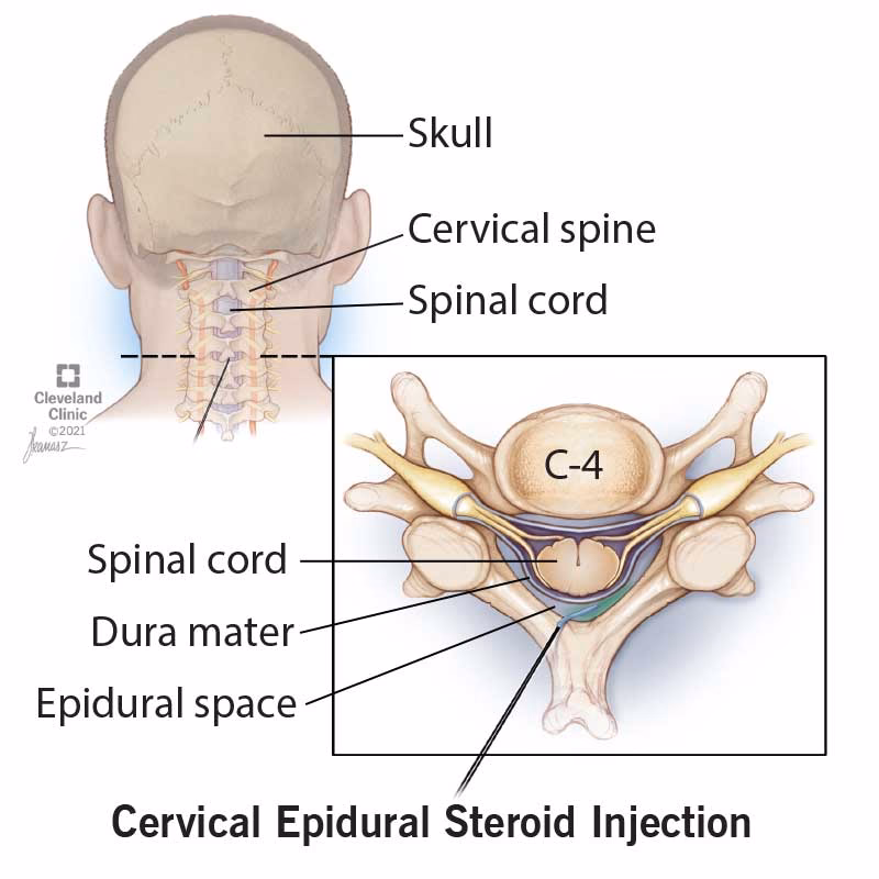 Does a cervical epidural steroid injection cause pain?