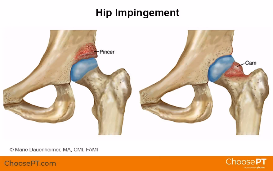 How do you know if your hip pain is causing pain?