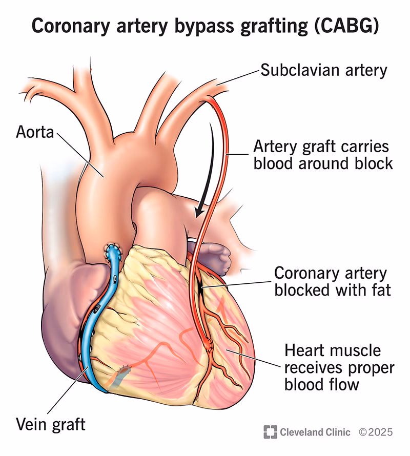 How long does a CABG stay in the hospital?