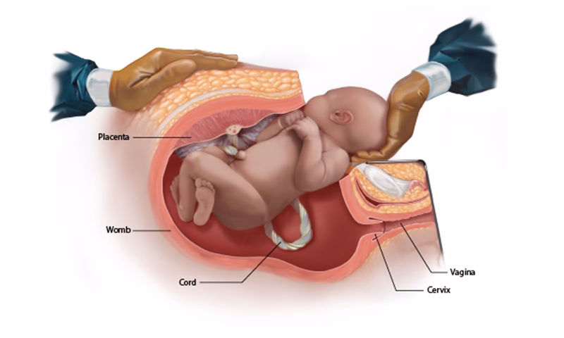 How is a caesarean performed?