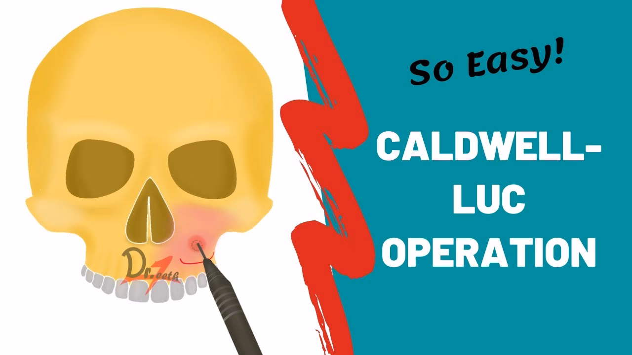 What is Caldwell Luc surgery?