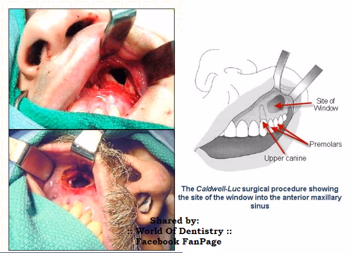 What is a Caldwell luc antrostomy?