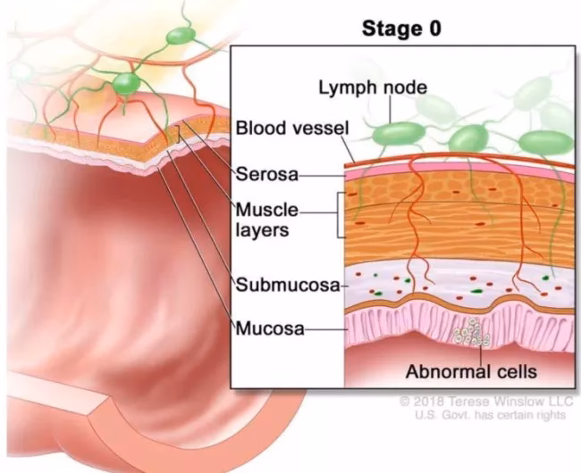 What is stage 0 breast cancer?