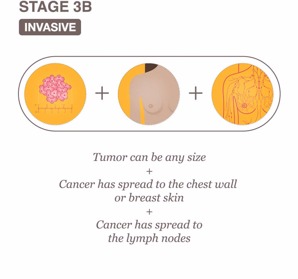What is Stage 3 cancer?