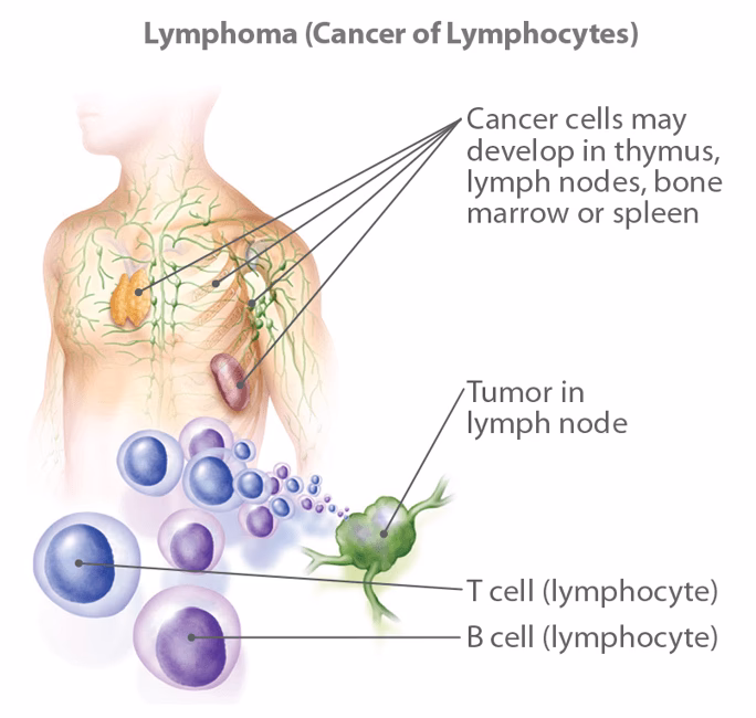 What is a large B cell lymphoma?