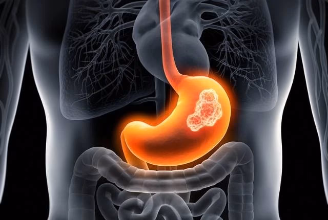 Quel est le pronostic du cancer de l’estomac ?