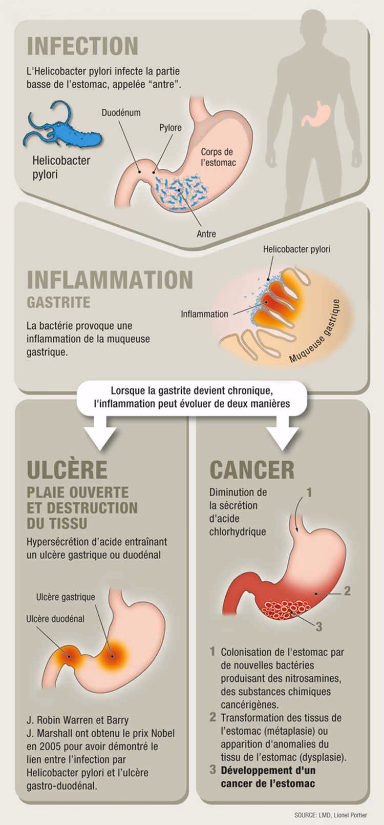 Quels sont les symptômes du cancer de l’estomac ?