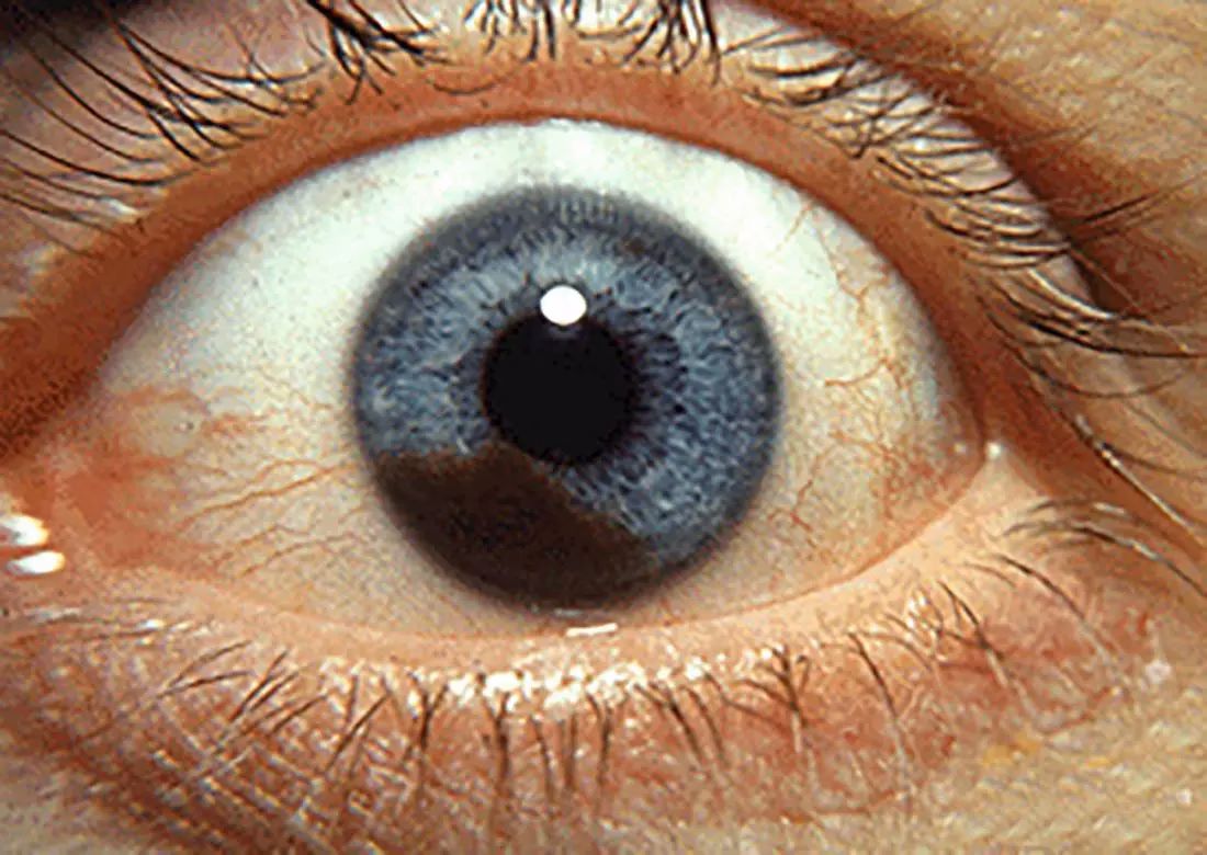 What causes eye cancer?