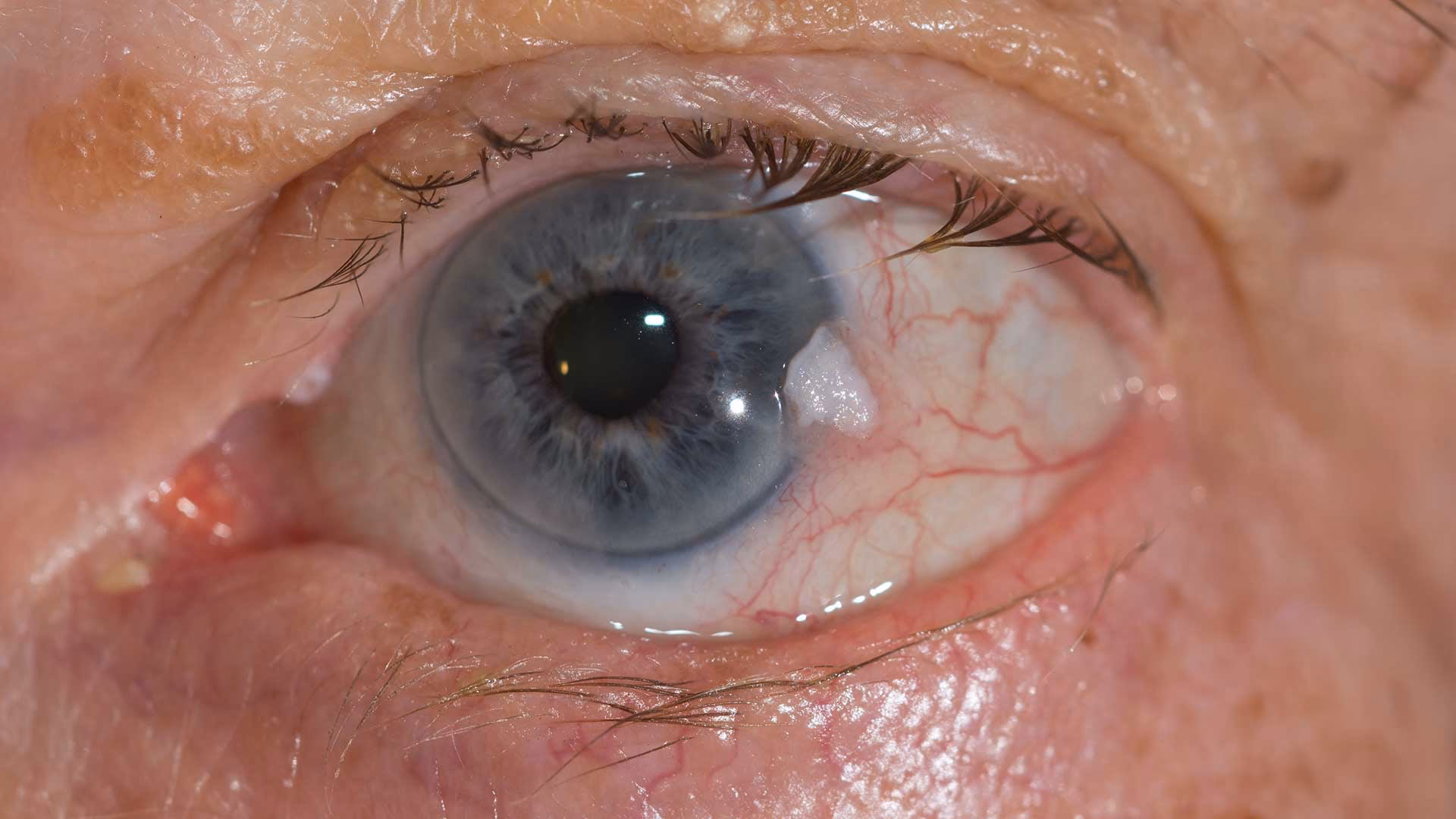 What type of eye cancer do you have?