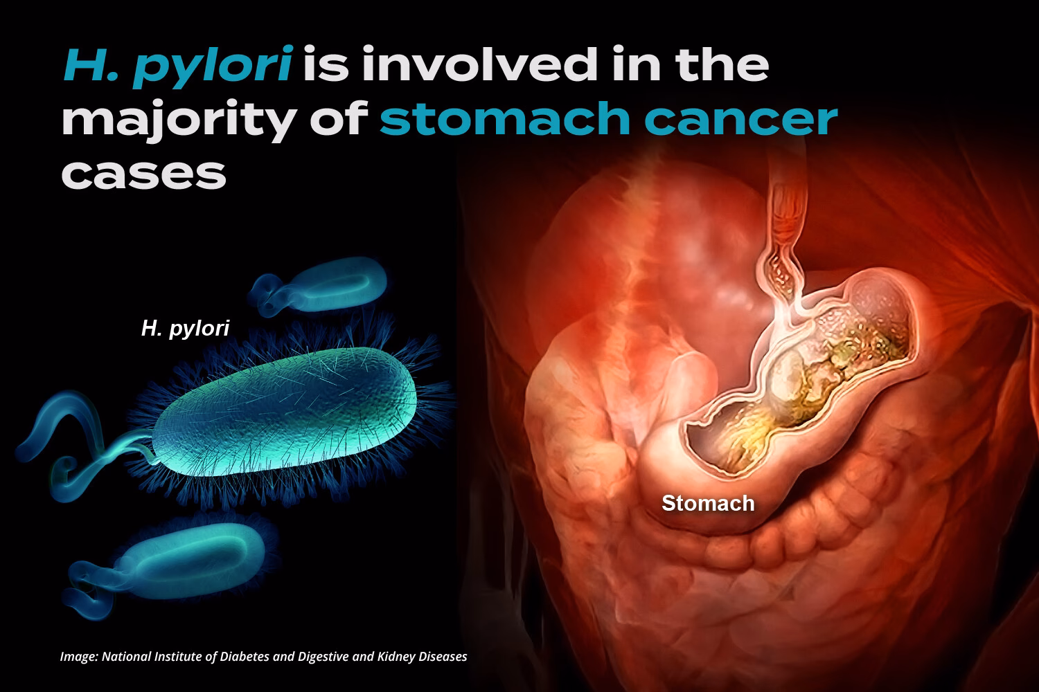Does H pylori cause cancer?