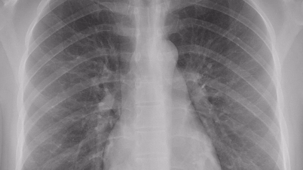 Can a chest X-ray show cancer?