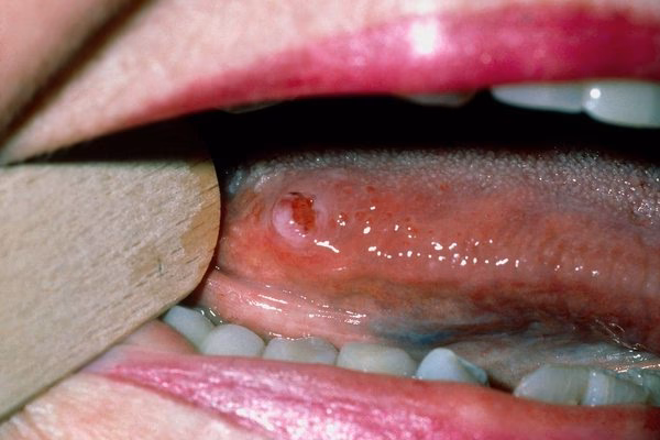 Can a mouth ulcer be an oral cancer?