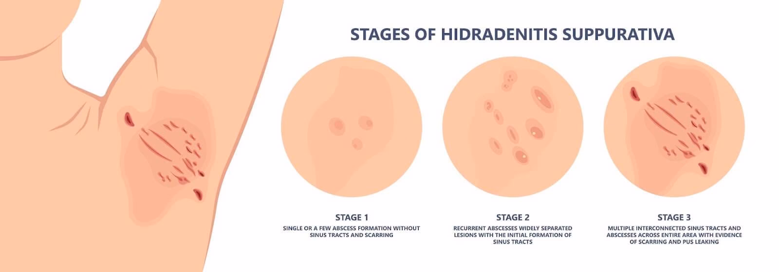 What are the treatment options for a cancerous lump in the armpit?