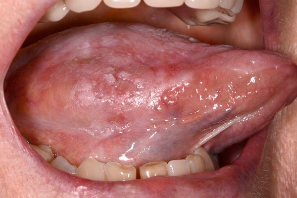 How is tongue cancer diagnosed?