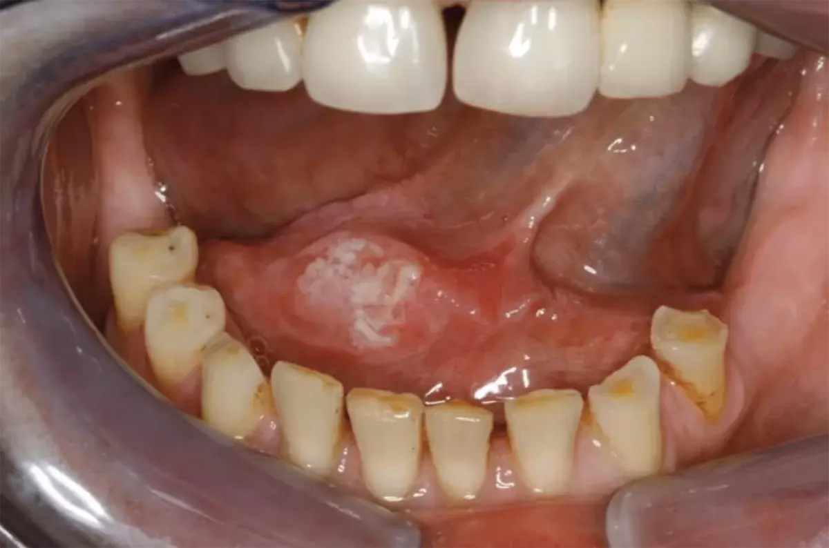 How is tongue cancer diagnosed?