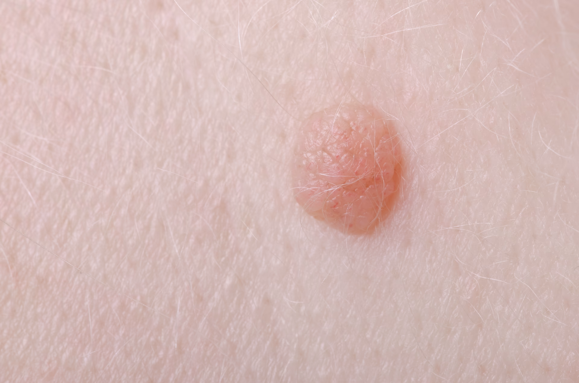 How do you know if a wart is cancerous?