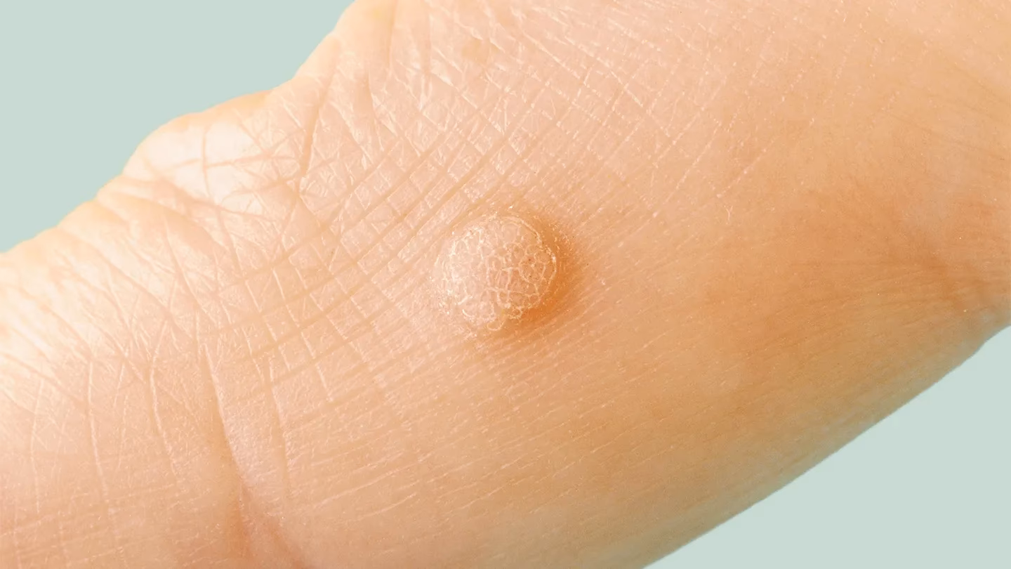 Can warts and skin cancer be mistaken for each other?