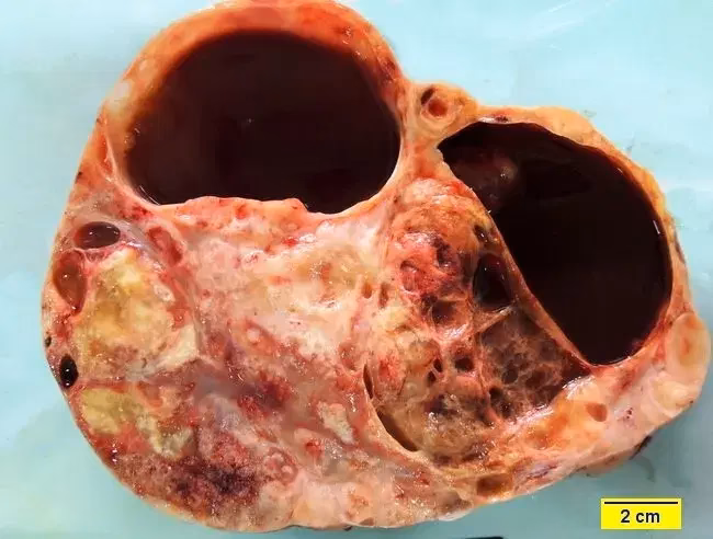What is the prognosis of a yolk sac tumor?
