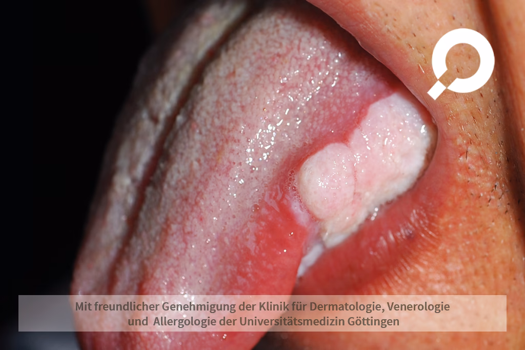 Was sind die häufigsten Candida-Spezies?