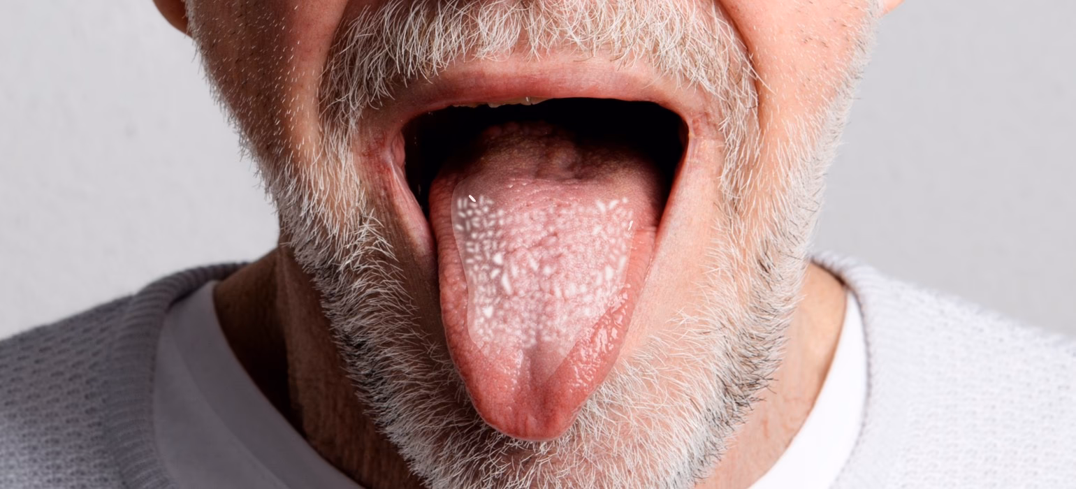 Was ist eine Candida-Infektion?