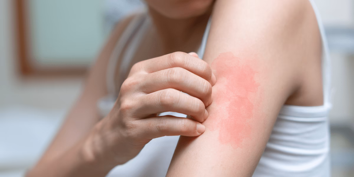 Can marijuana exacerbate allergy symptoms?