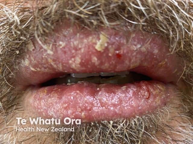 What causes carnauba wax allergies?