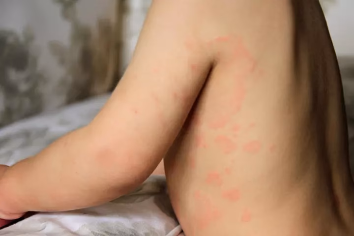 Can you be allergic to carrots?