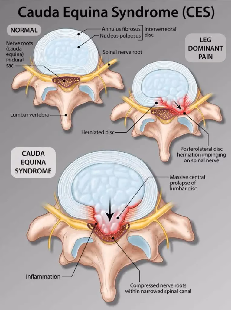 Are cauda equina nerve roots regenerative?