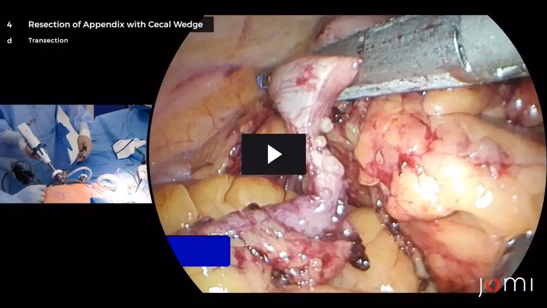 What are the different types of surgery for cancer of the cecum?