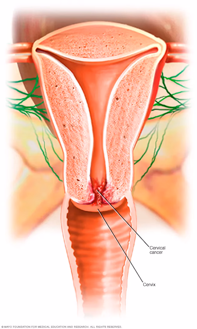What causes cervical cancer?