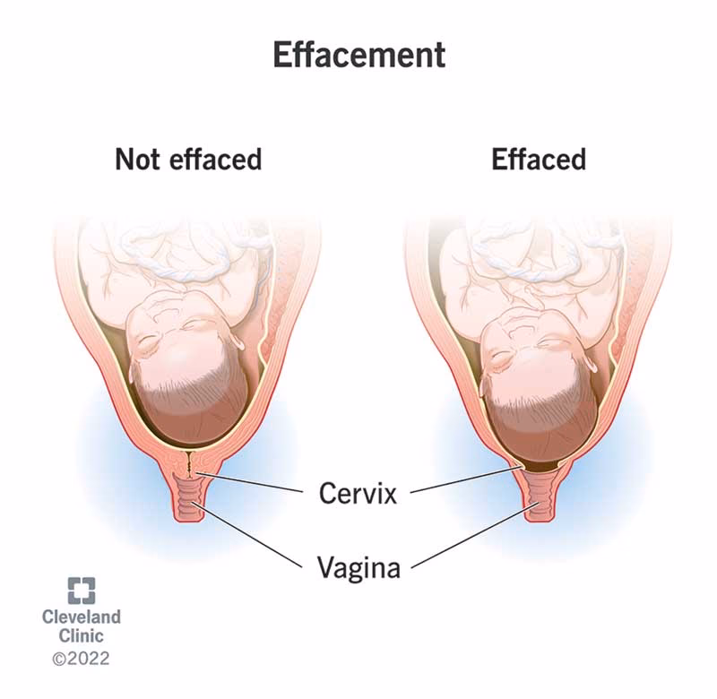 What happens to the cervix during labor?