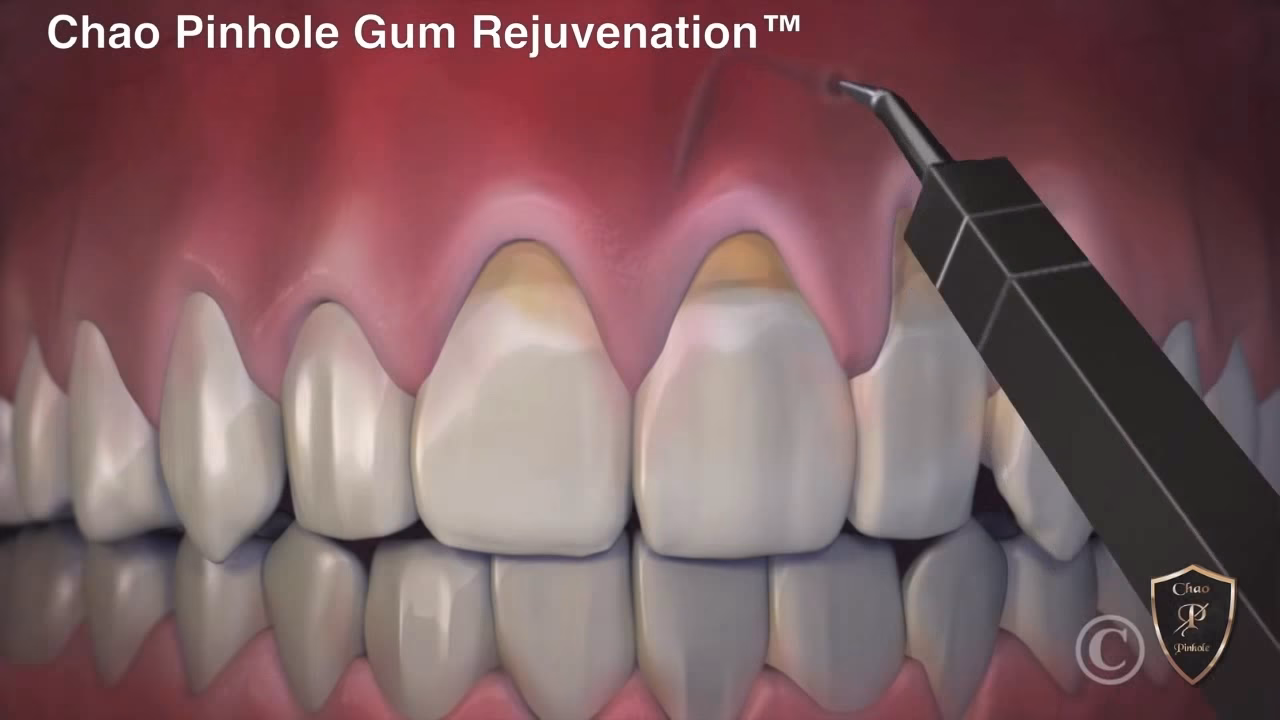 What is pinhole® gum rejuvenation?