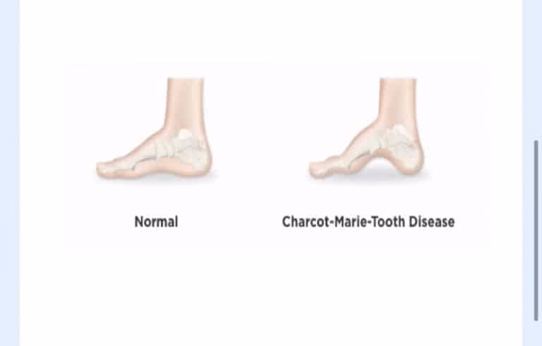 Can a 66-year-old woman with Charcot-Marie-Tooth disease undergo a 2-stage revision?