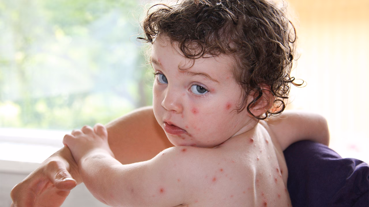 Do children have chickenpox?