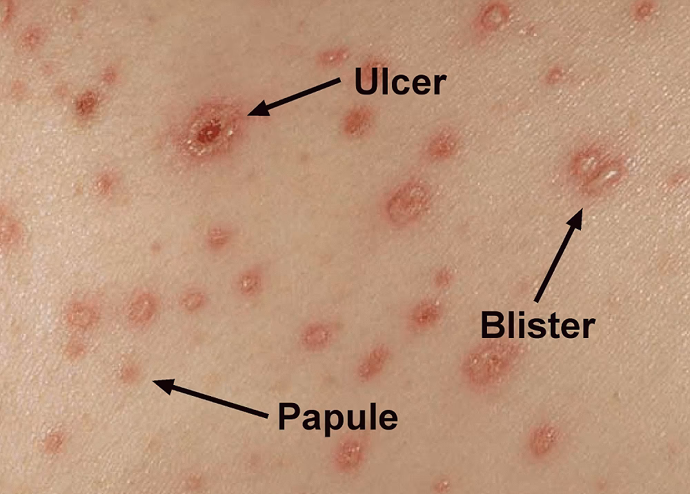 When do chickenpox symptoms start?