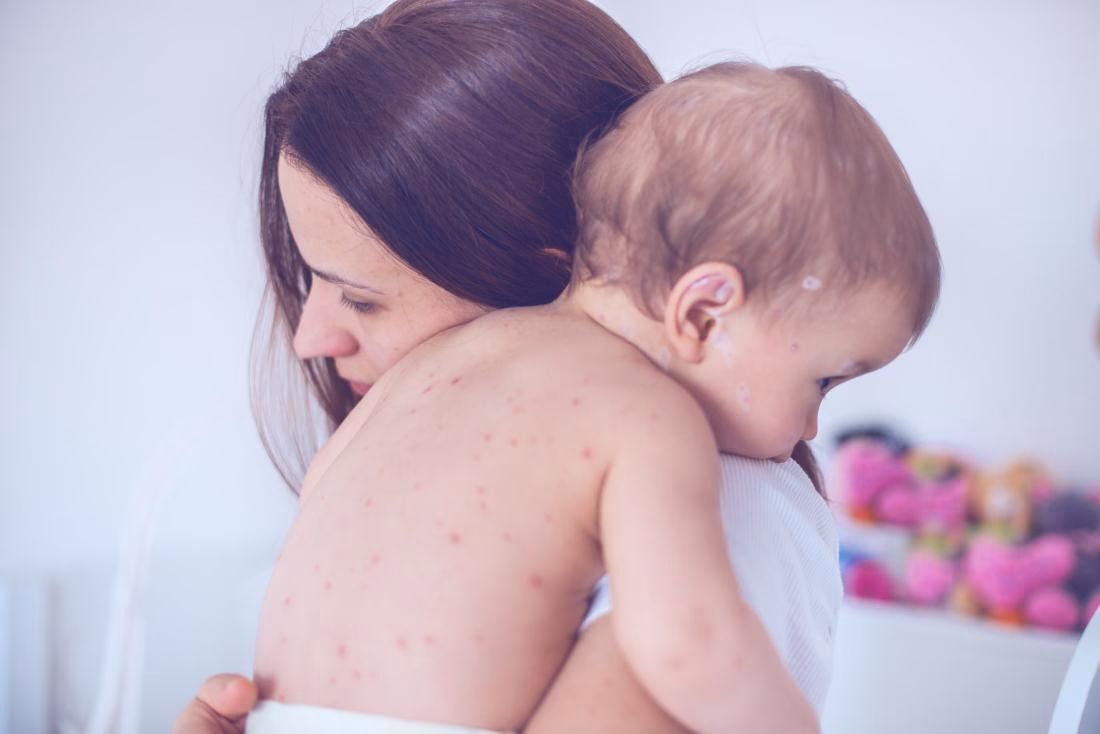 How do you treat chickenpox itch in a breastfeeding woman?